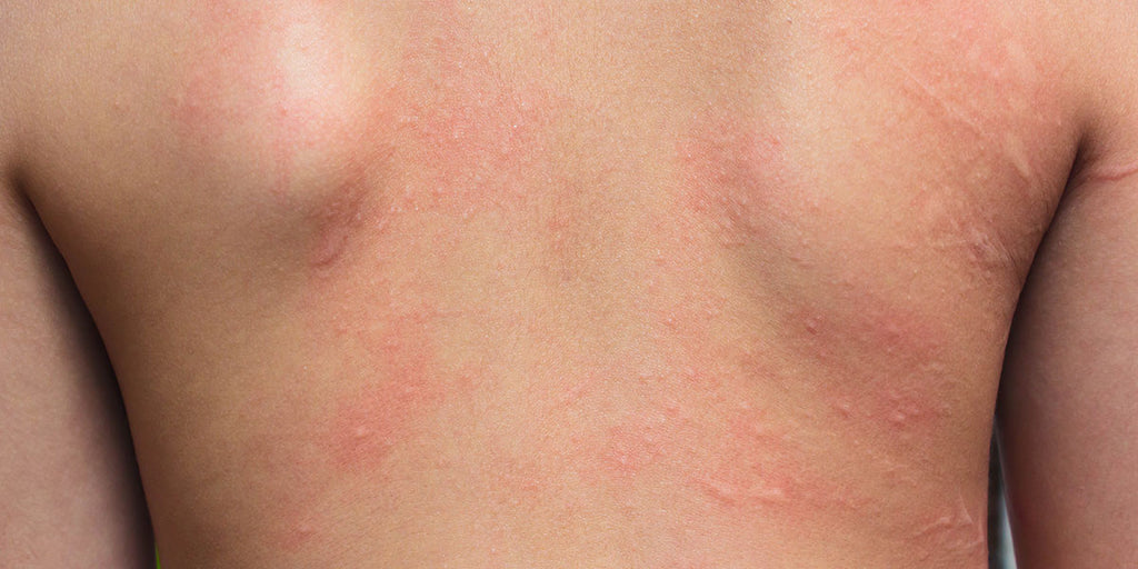 接触性皮炎(Contact dermatitis)